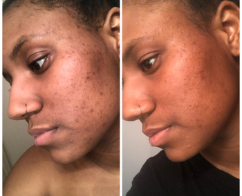 A reviewer showing before and after pictures of their skin