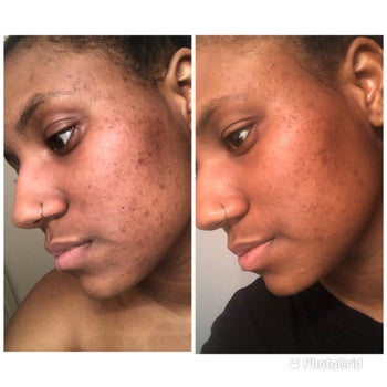 A reviewer showing before and after pictures of their skin