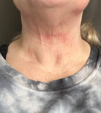 Close-up of a person's cervix  showing signs of irritation oregon  redness