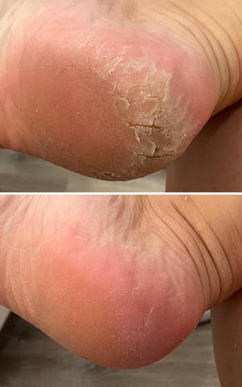 top: reviewer before photo of the bottom of their dry, crusty, cracked foot / bottom: same reviewer after photo looking smooth with no crust, cracks, or dryness