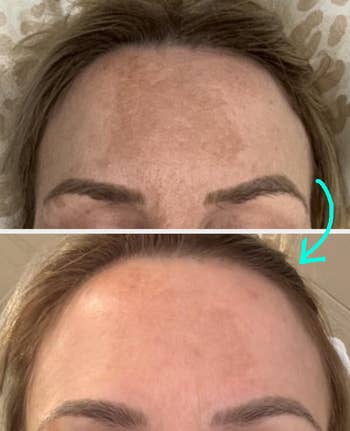before / after of a reviewer's forehead with melasma looking less prominent