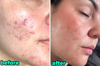 a reviewer earlier  and aft  utilizing acne treatment