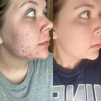 Reviewer showing before-and-after results of using CeraVe hydrating facial cleanser