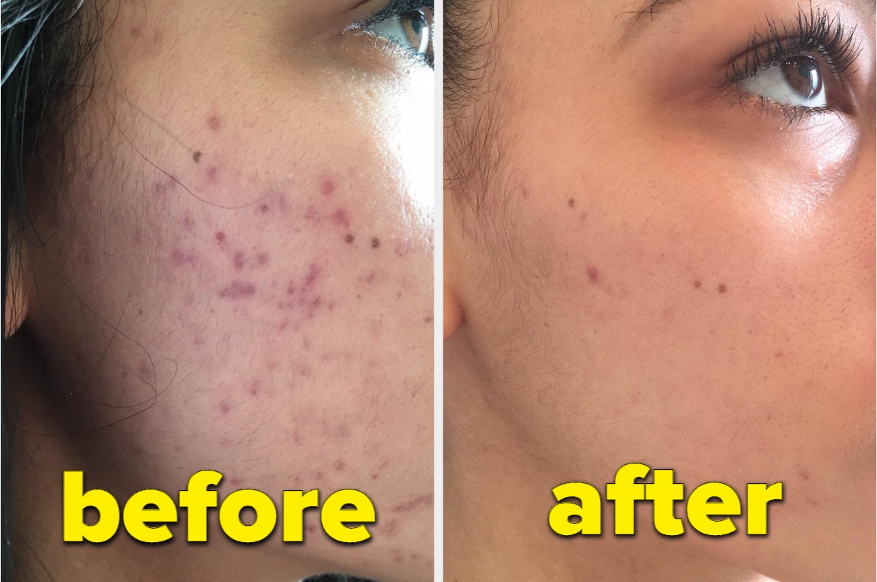 a reviewer's before and after showing how their acne scars have significantly faded