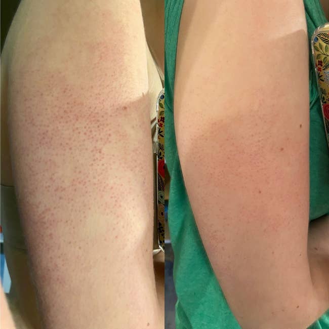 before and after images of a reviewer's arm with red bumps that start to disappear