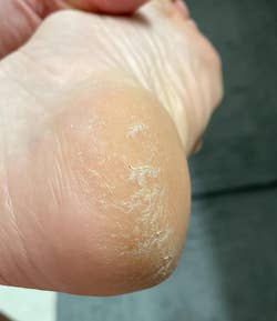 Reviewer's foot before using pumice sponge