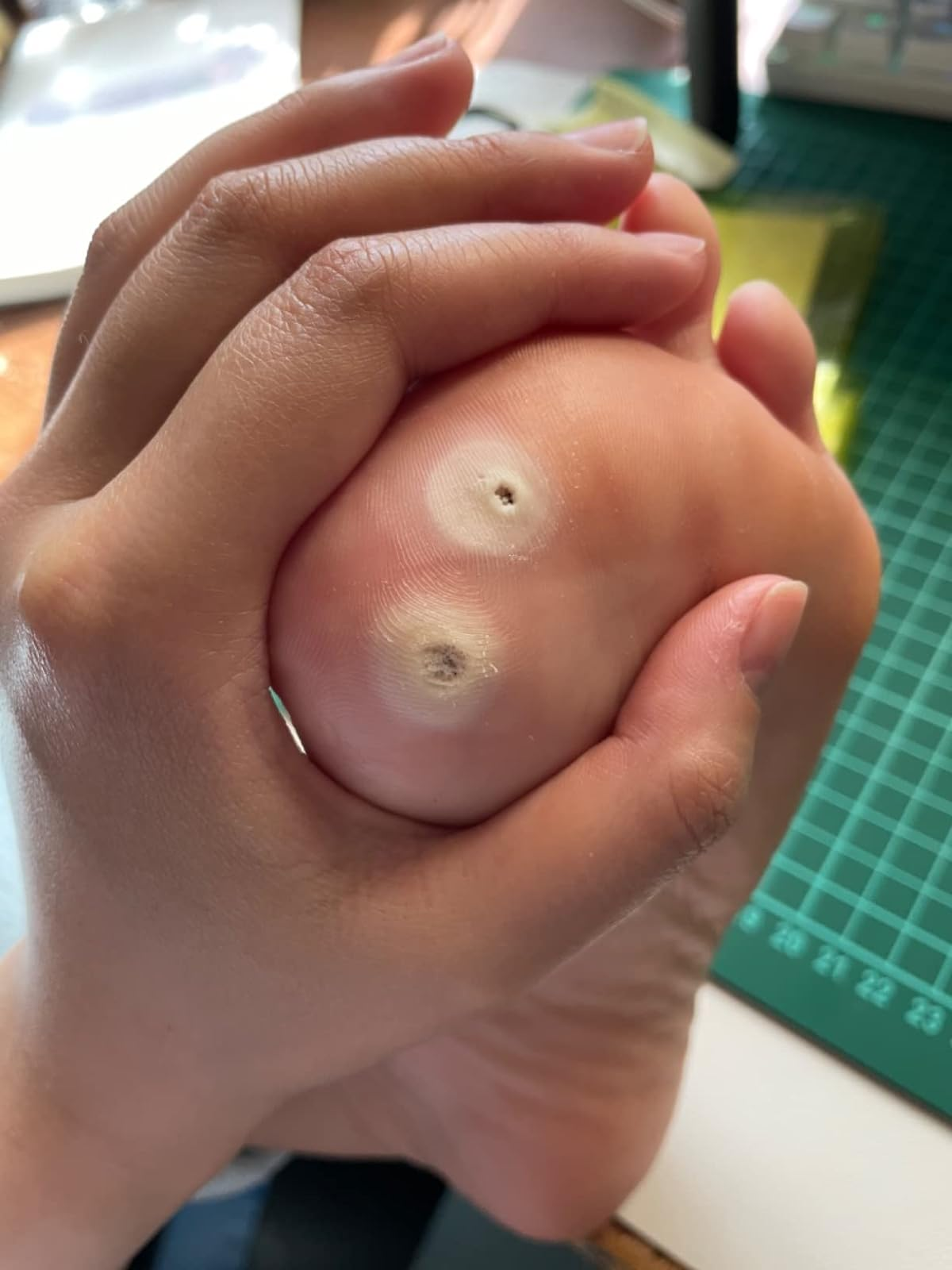 Close-up of a idiosyncratic   inspecting their foot, focusing connected  2  plantar warts connected  the sole