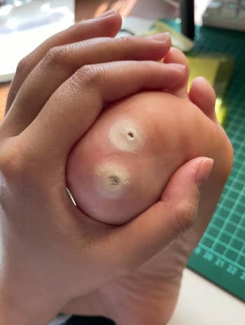 Close-up of a idiosyncratic inspecting their foot, focusing connected 2 plantar warts connected the sole