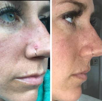 before/after of reviewer's face/nose showing decreased redness and a bump at a piercing that's disappeared