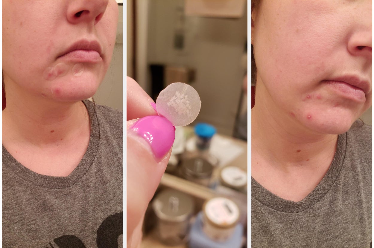 reviewer side-by-side of their chin with acne patches on it, then a used pimple patch, then their chin again after the acne patches