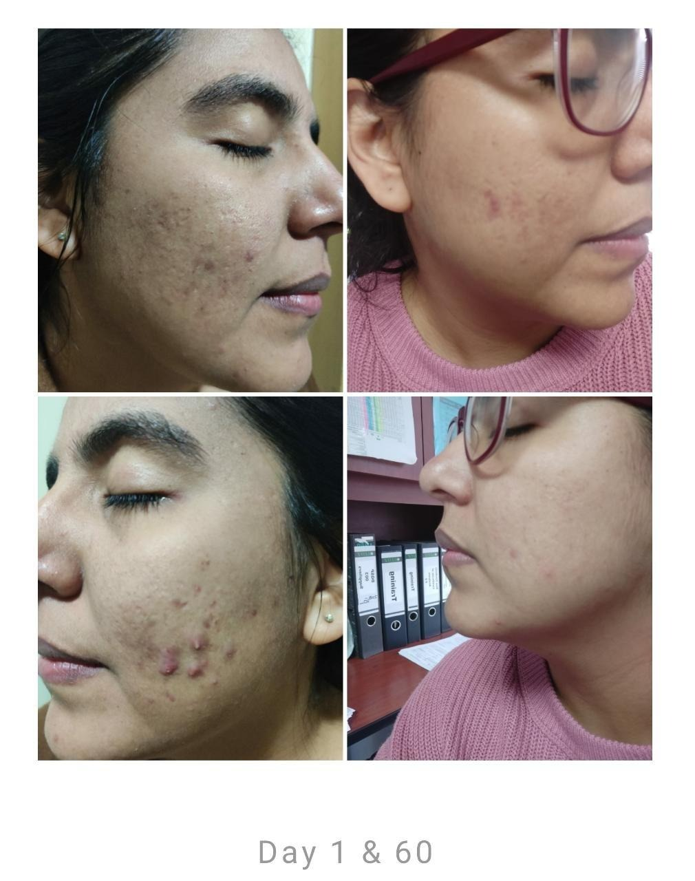 side by side before and after pics of a reviewer with acne and acne scars and then with clear skin