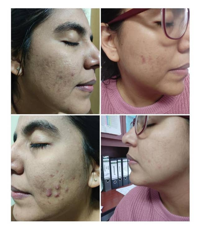 side by side before and after pics of a reviewer with acne and acne scars and then with clear skin