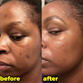 Different reviewer's results of using Differin gel after five weeks, with the before picture showing breakouts and hyperpigmentation on their cheek and the after photo showing their face noticeably clearer without breakouts or hyperpigmentation
