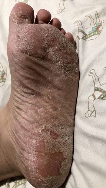 before image of a reviewer's foot covered in calluses