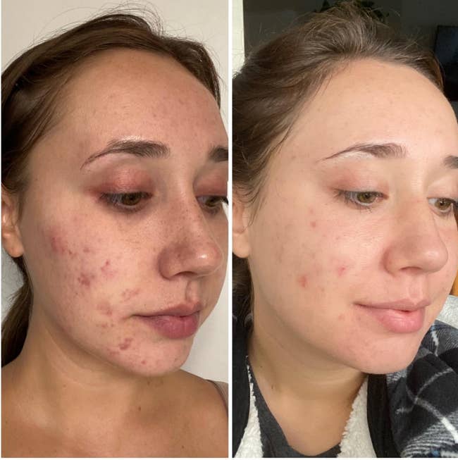 before of reviewer with acne and after with cleared up skin