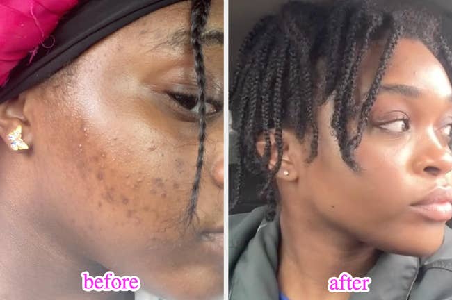 Before and aft photos of a reviewer, showing important betterment successful tegument clarity and texture. The