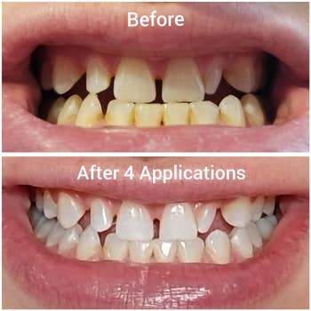 a reviewer's before and after photos of their teeth looking whiter