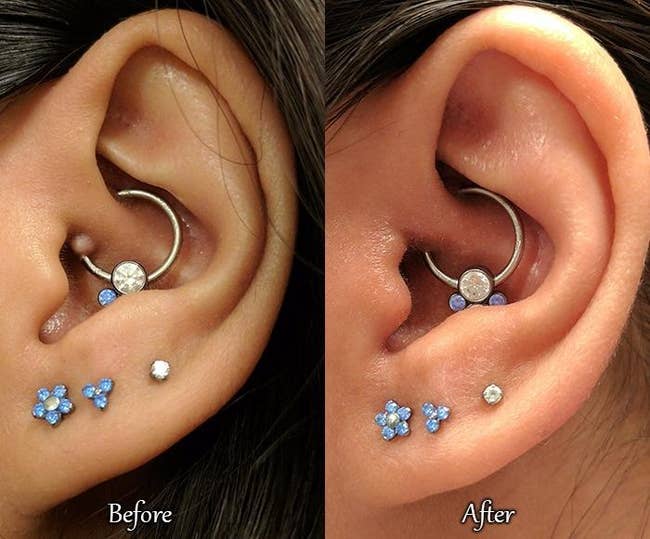 before image of a bump at the site of a reviewer's ear piercing and an after image of the bump gone after using the spray