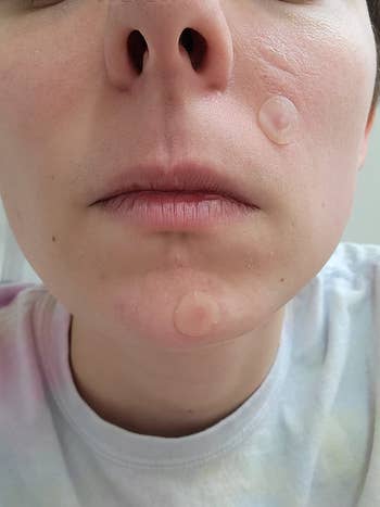 Close-up of a person's look with 2 small, circular acne patches connected the chemoreceptor and chin, demonstrating their usage successful skincare