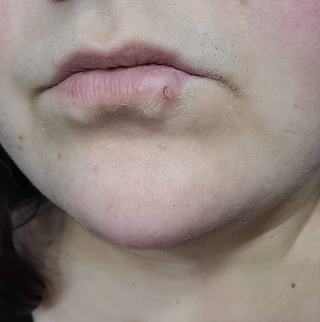 image of a spot connected a acold sore connected a reviewer's lip