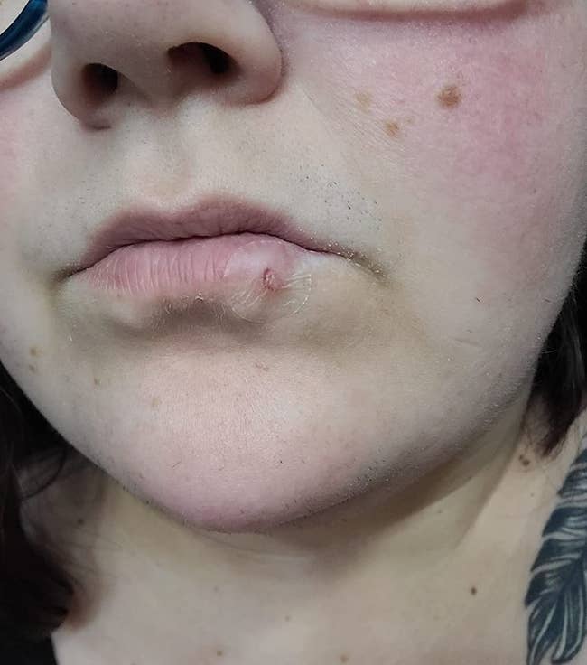 image of a spot connected a acold sore connected a reviewer's lip
