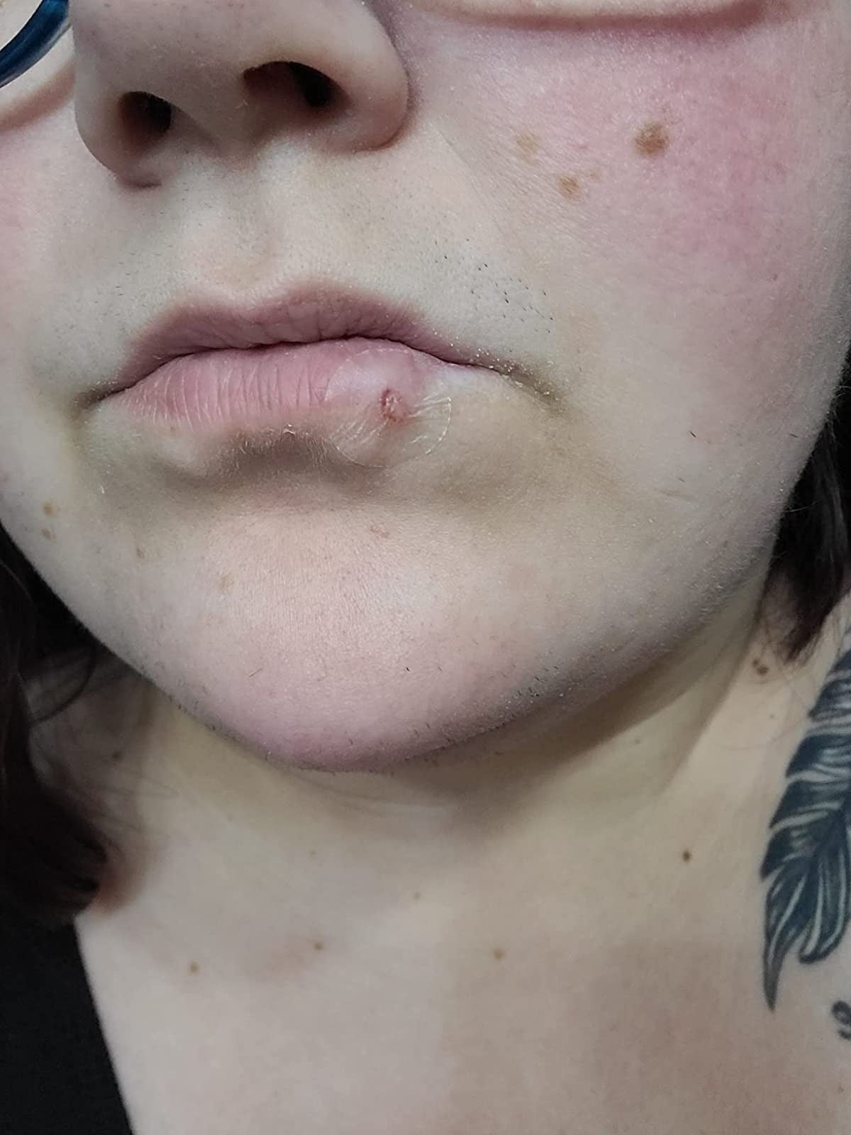 image of a patch on a cold sore on a reviewer's lip