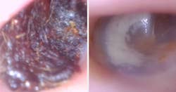 on the left, the inside of a reviewer's ear with a lot of wax and on the right the same reviewer's ear now much cleaner