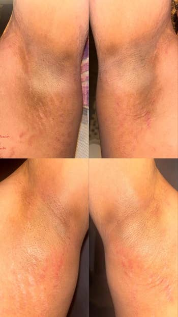 Close-up of 2 sets of underarms showing earlier and aft results of skincare treatment, with smoother tegument texture successful the aft images