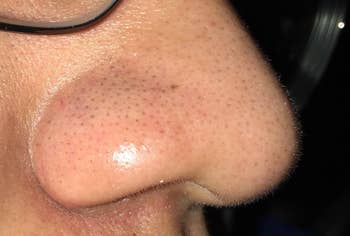 blackheads on side of nose