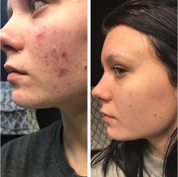 Before and after images of reviewer with acne and then clearer skin