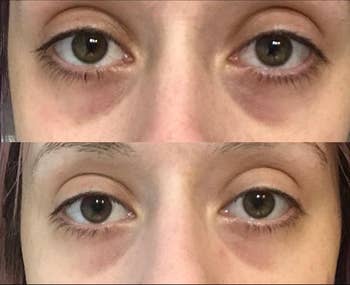 reviewer's dark undereye circles before and then less noticeable after using the cream