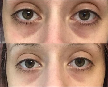 Reviewer showing results of using CeraVe eye cream