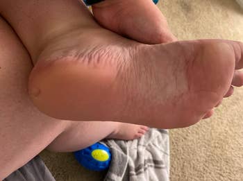 reviewer foot after using callus remover with feet much smoother