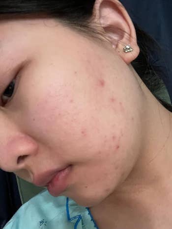 reviewer with acne before moisturizer