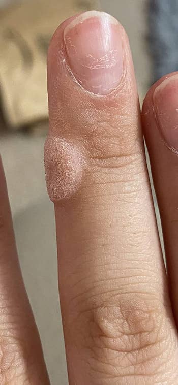 before photo of a large wart on the side of a finger