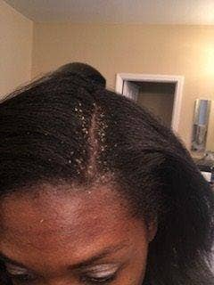 a reviewer photo with white flakes along their scalp 