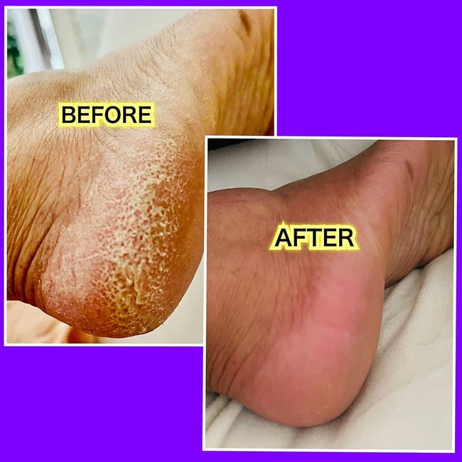 side by side reviewer before and after images of a foot covered in cracks and then that same foot smooth and crack-free