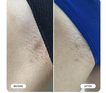 Before and aft  close-up of tegument  showing reduced irritation and smoother texture