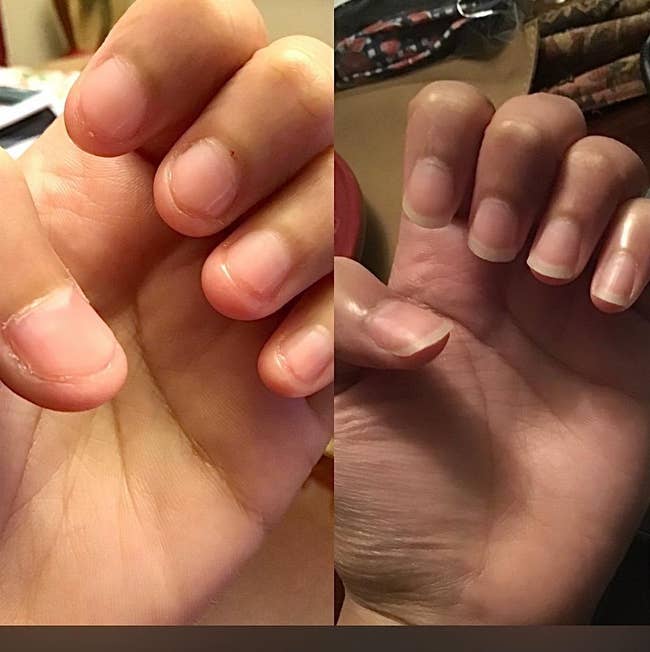 Reviewer before and after with nails bitten to the point of swelling at the fingertips and the nails long and healthy after use 