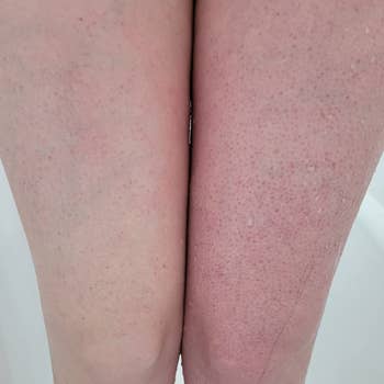 image of reviewer whose left leg is red and covered in bumps but their exfoliated right leg is smooth and not red
