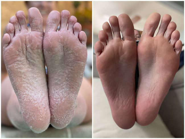 Close-up of a person's feet before and after using a moisturizing product, showing dry skin and then improvement