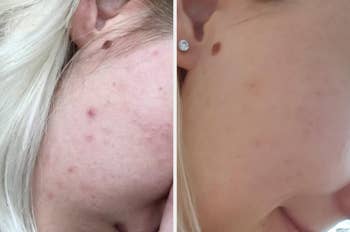 before and after image of reviewer's acne prone skin now smoother and more even toned 