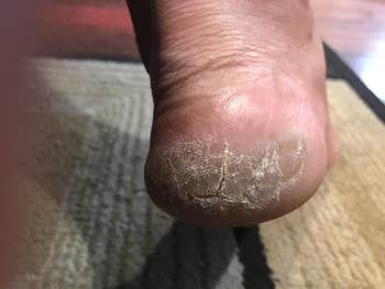 reviewers dry cracked heel