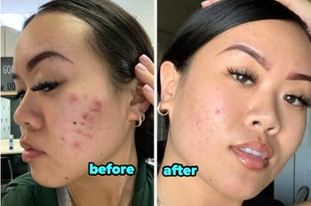 Side-by-side comparison of a person's face before and after using mask, showing improvement with acne