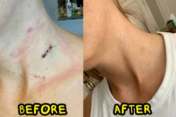 before and aft utilizing bio lipid skincare serum
