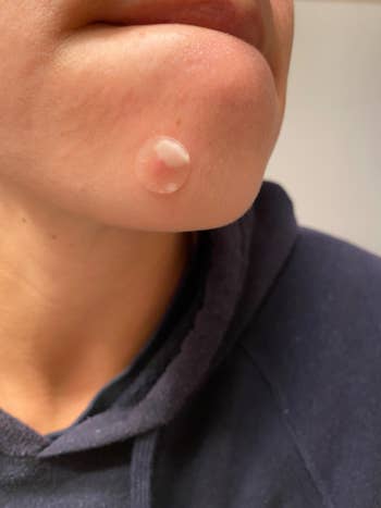 reviewer wearing pimple patch on chin with gunk on it