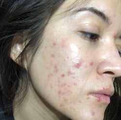 before image of reviewer with acne and red marks