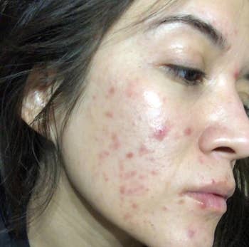 before image of reviewer with acne and red marks