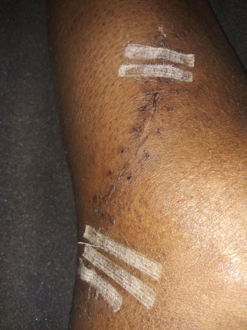 image of a reviewer's dark knee scar