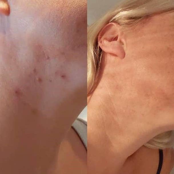 on the left, a reviewer with acne along their jawline and, on the right, the same reviewer with the acne no longer present 